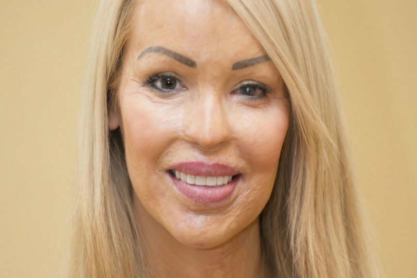 Katie Piper e l’amore che lascia il segno